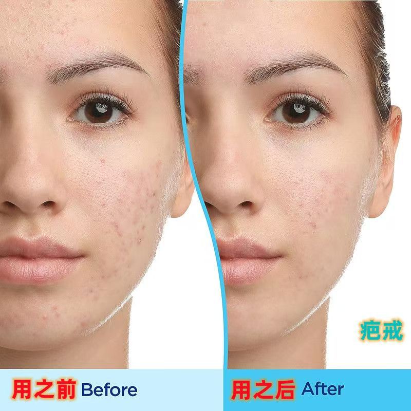 Cross-Border Acne Treatment Gel Moisturizing Gel Is Suitable For Sensitive Skin And Gentle Skin Care