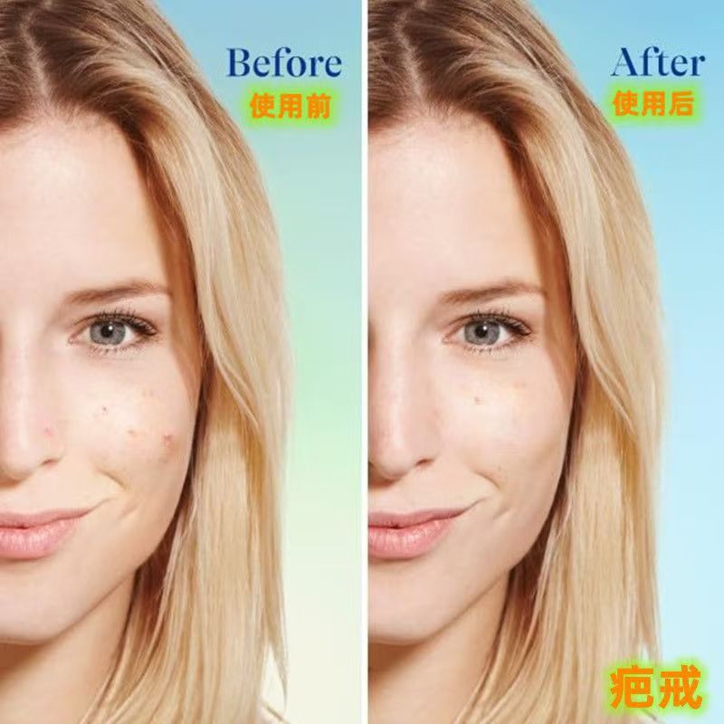 Cross-Border Acne Treatment Gel Moisturizing Gel Is Suitable For Sensitive Skin And Gentle Skin Care